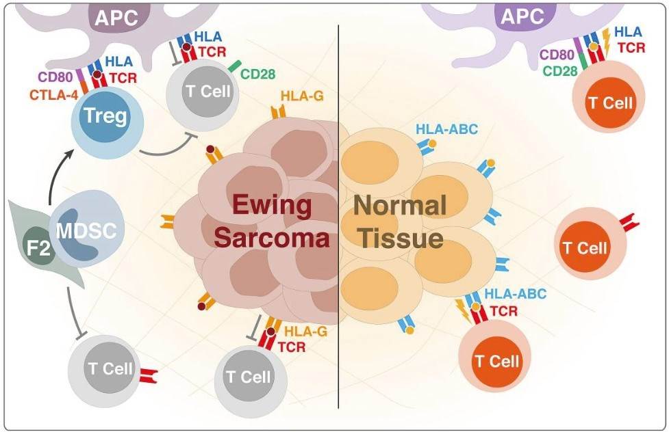 Immunosuppression in the Ewing sarcoma tumor microenvironment.