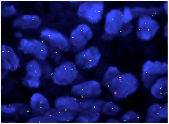 Molecular study of Synovial Sarcoma (SS) by fluorescence in situ hybridization (FISH).