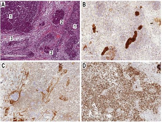 Pathology of Pediatric Extra-Renal Nephroblastoma (Wilms' Tumor)
