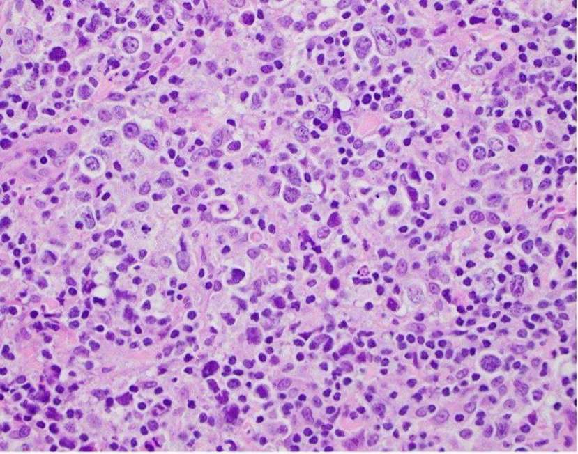 A case study of histopathological analysis of primary bone lymphoma.