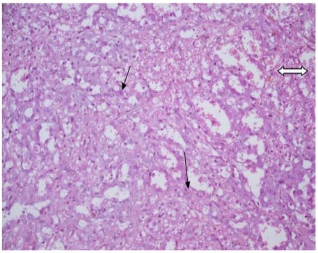 Histological image showing vascular proliferation made of vessels lined with atypical cells.