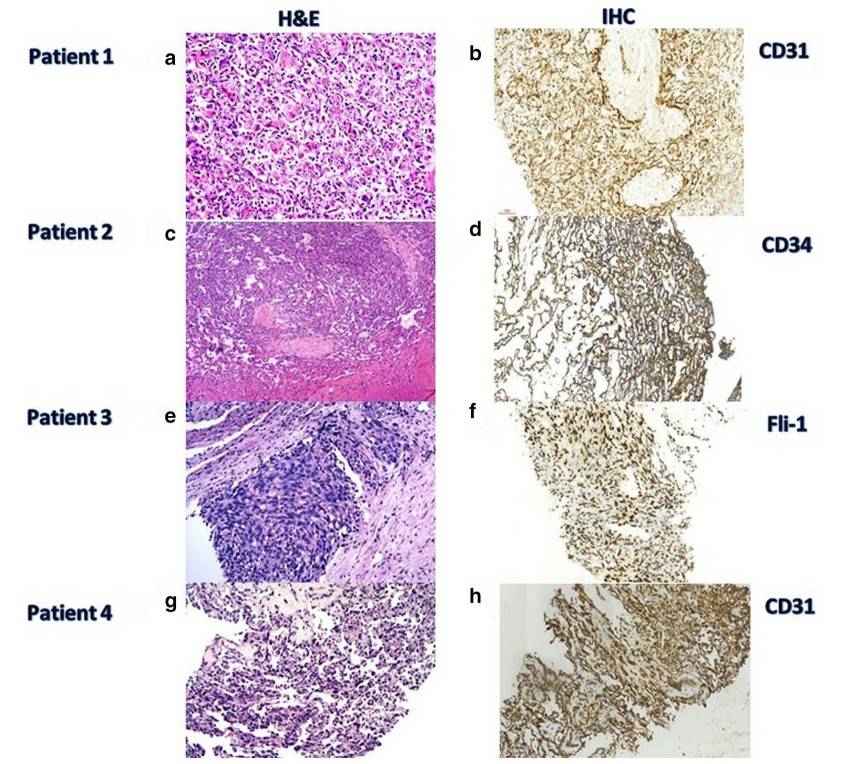 Four cases of histopathological analysis of Primary Hepatic Angiosarcoma (PHA).