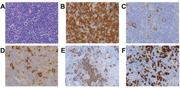 Histopathological analysis of pulmonary lymphomas.