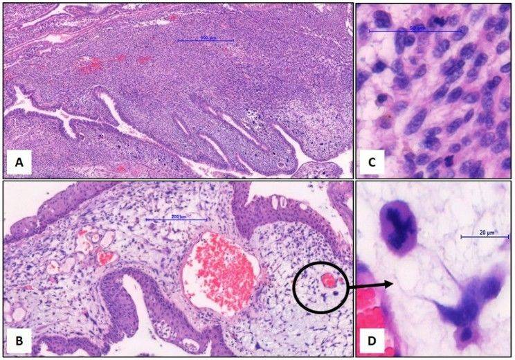 Pathological analysis of prostatic stromal sarcoma.