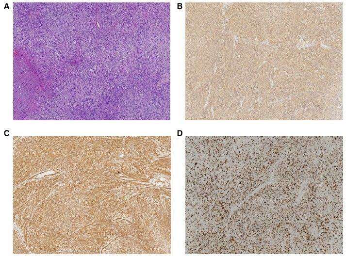Pathological analysis of penile leiomyosarcoma.