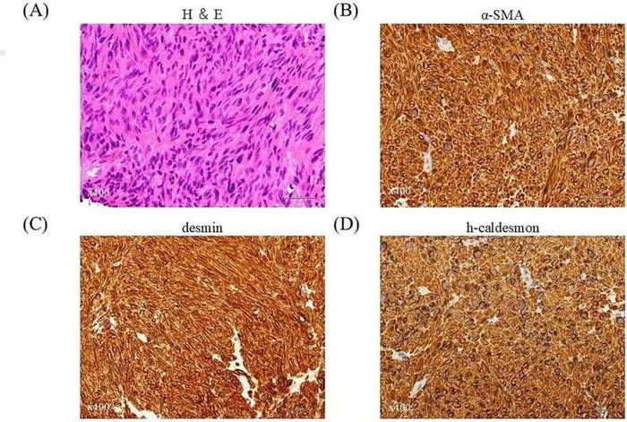 Tumor biopsy findings of a case of prostate leiomyosarcoma.