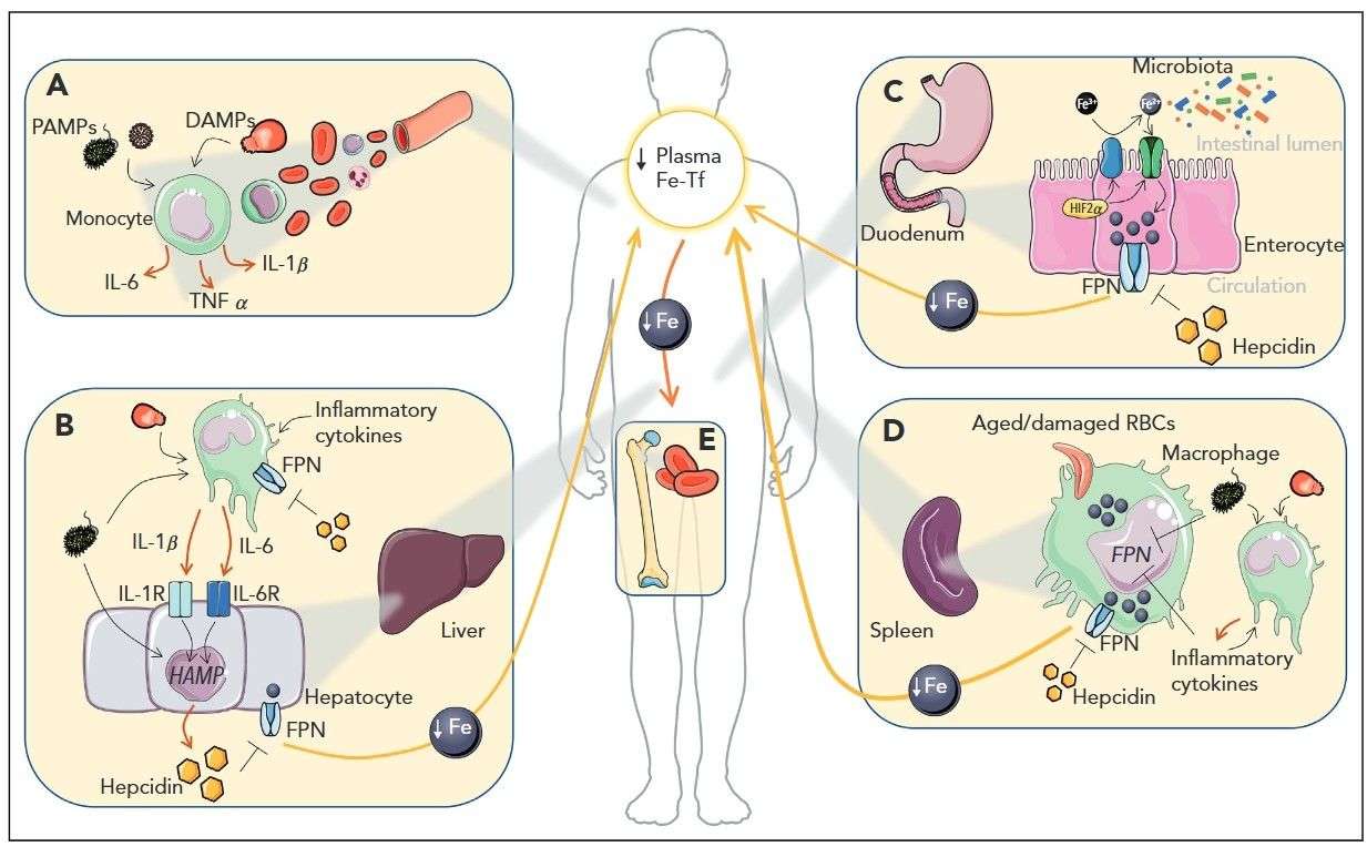  Iron-mediated pathways in anemia of inflammation. 