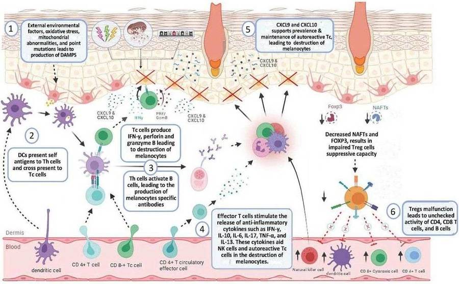 Vitiligo pathogenesis mechanism.